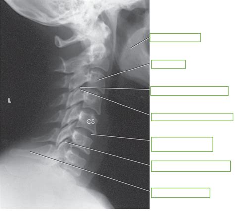 Lateral Cervical Spine Diagram Quizlet