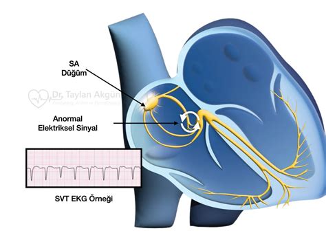 Supraventriküler Taşikardi SVT Nedir Neden Olur