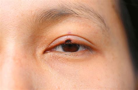 Eyelid Cancer All About Vision