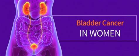 Bladder Cancer In Women - Symptoms, Risk Factors & Treatment | Cxbladder