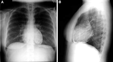 Pericarditis Xray