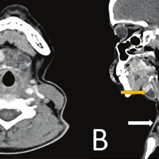 Axial A And Mid Sagittal B Contrast Enhanced Computed Tomography