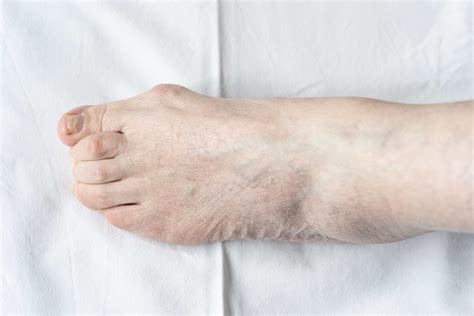 Get Relief with Claw Toe Surgery in Miami from $5000