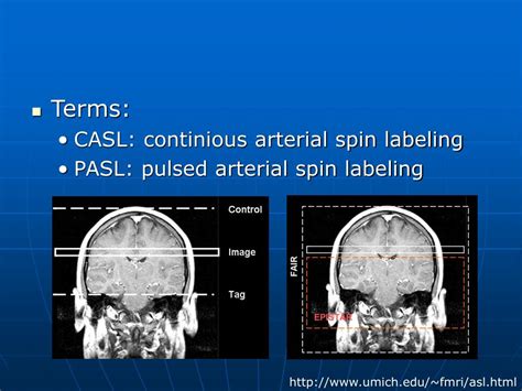 Ppt Arterial Spin Labeling Powerpoint Presentation Free Download