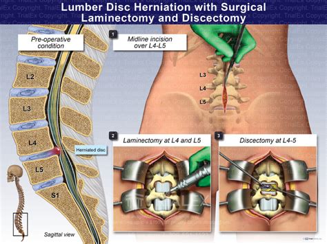 Discectomy And Laminectomy