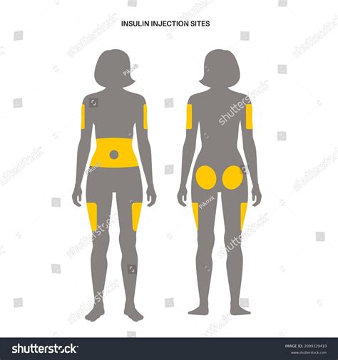 Diabetes Treatment Insulin Injection Sites On Stock Vector (Royalty ...