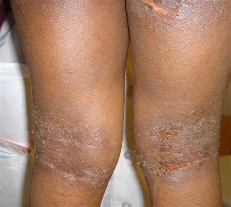 Atopic Eczema On Black Skin