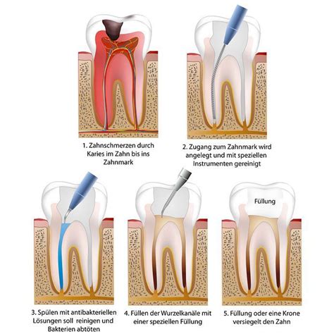 Wurzelkanalbehandlung Zahn Rzte Wermelskirchen Feyka Dufhaus