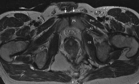 Athletic Pubalgia And Sports Hernia Optimal MR Imaging Technique And