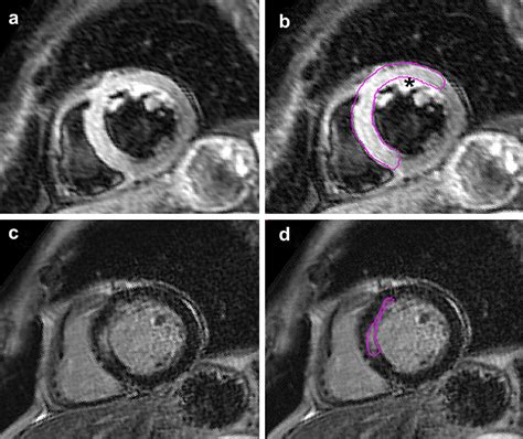 Long Term Prognostic Value Of Myocardial Salvage Assessed By