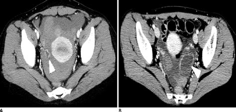 Hemorrhagic Corpus Luteum Ultrasound