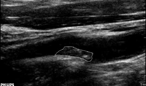 Atherosclerotic Plaque Ultrasound Video Frame The Atherosclerotic Download Scientific Diagram