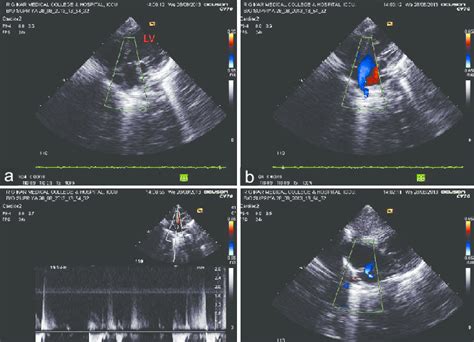 Transthoracic Echocardiography Showing The Following A Apical Five