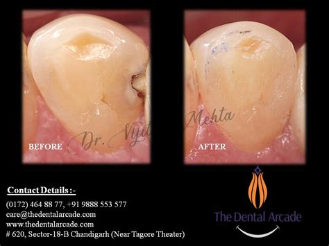 Composite restoration | The Dental Arcade – Blog