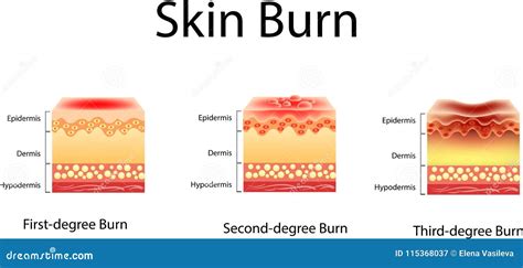 Skin Burn Injury Treatment Infographic First Aid For Damage Cartoon