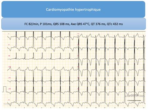 Ecg P Diatrique Urgence Chu Sainte Justine