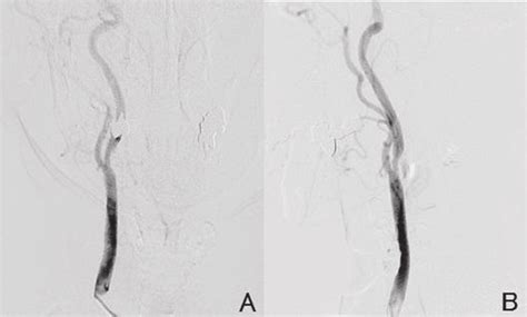 Right Common Carotid Angiogram Shows Internal Carotid Artery Stenosis