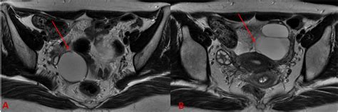 Mri Finding For Case 2 8cm Sized Multilocular Cyst With Multiple