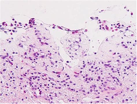 Skin Biopsy Shows Complete Sloughing And Loss Of Epidermis Due To Download Scientific Diagram