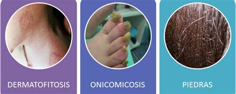 Diplomado Diagnostico En Micología Clínica Micosis Superficiales