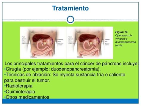 Cáncer De Páncreas Up Med