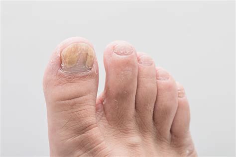 Toenail Fungus Causes Symptoms And Treatment