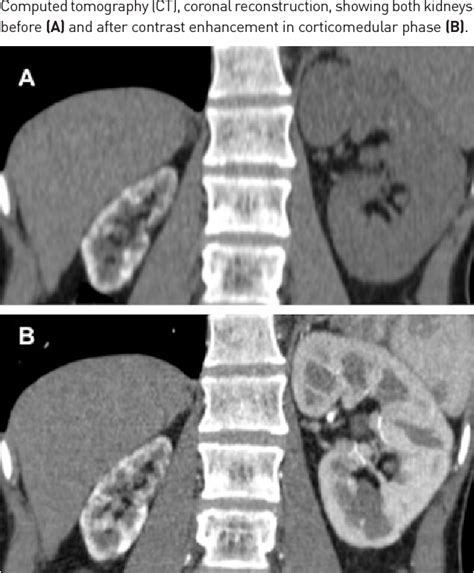 Pdf Cortical Nephrocalcinosis Asymmetrically Involving The Kidneys A