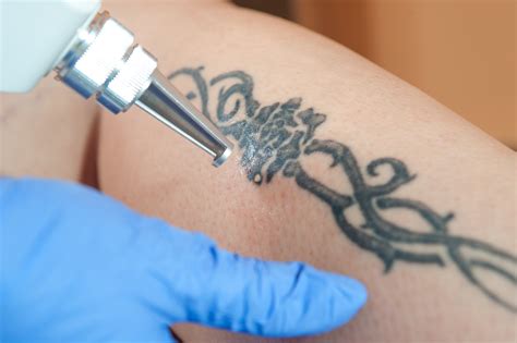 Things You Should Know About Laser Tattoo Removal Alma Lasers