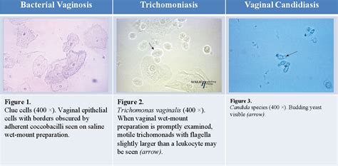 Accuracy Of Self Collected Vaginal Swabs In The Diagnosis Of Bacterial