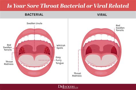 Elegant What Does Strep Look Like If You Don T Have Tonsils