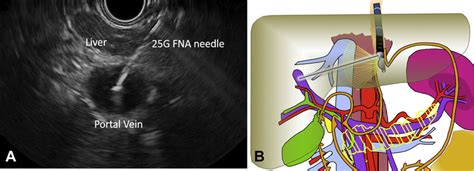 A Eus Image Of Transgastric Transhepatic Needle Puncture Into The