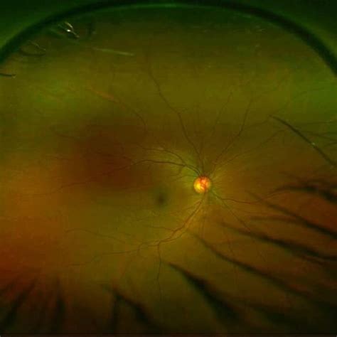 Intraocular Pressure (IOP) - Outlook Eye Specialists