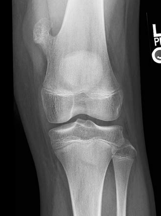 Osteochondroma | Radiology Reference Article | Radiopaedia.org