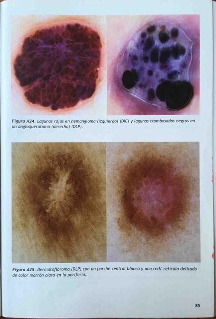 Imagenes Con Dermatoscopio PARTE II Manual Dermatoscopia Dra