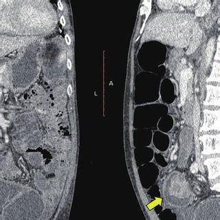 Axial Views Of The Ct Abdomen Showing A Mass Within The Rectosigmoid