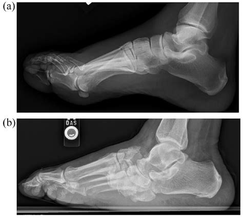 Fractures And Dislocations Of The Foot And Ankle In People With