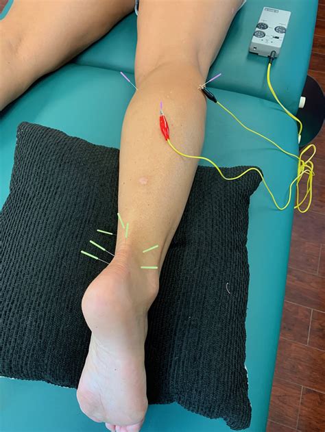 Whats Is Dry Needling — Physical Therapy For The Athlete In All Of Us