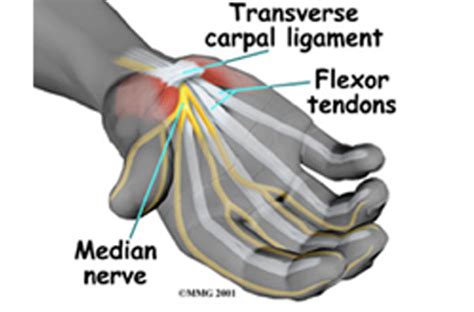 Repetitive Motion Disorders