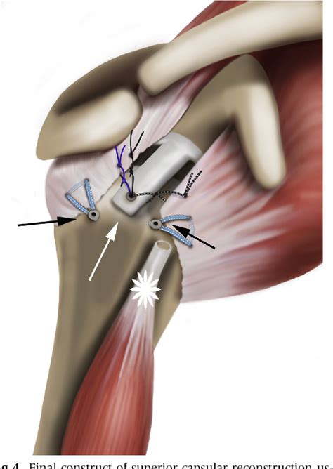 Figure From Long Head Of The Biceps As A Suitable Available Local