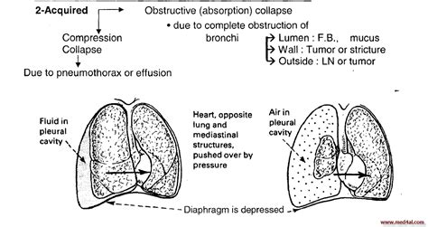 Lung collapse causes, manifestations, DDx, investigations and treatment ...