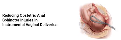 Reducing Obstetric Anal Sphincter Injuries In Instrumental Vaginal Deliveries