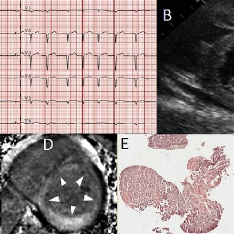 Multimodality Imaging Of A Patient With Advanced Attr Cardiac