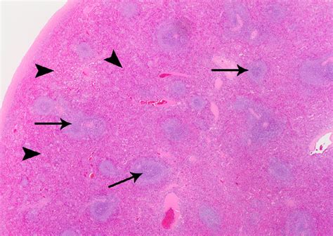 Microscopy Of The Excised Splenic Parenchyma From Fig 4 12