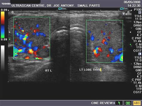 A Gallery Of High Resolution Ultrasound Color Doppler And 3d Images