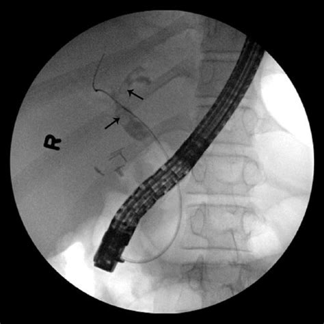 Endoscopic Retrograde Cholangiopancreatography Showing Arrows