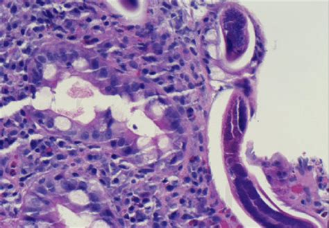 Sigmoid Colon Biopsy Larvae Hande 400× Download Scientific Diagram