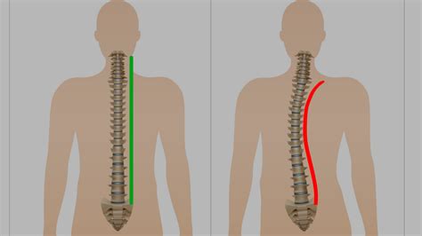 Esercizi Scoliosi Nell Adulto La Chiave