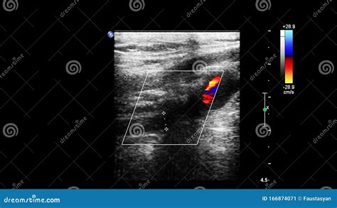 Pulse Wave Doppler Ultrasound Examination. Stock Image - Image of ...