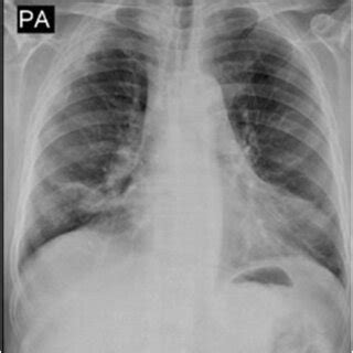 Chest X Ray Posterior Anterior View Showing Bilateral Nonhomogeneous