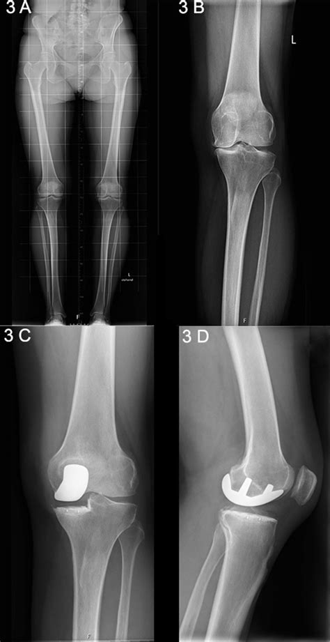 Radiographic Positioning Of The Knee